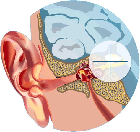 Acoustic Neuroma Radiotherapy As A Treatment Option
