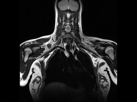 Non Invasive Nerve Plexus Imaging Philips Mr Body Map