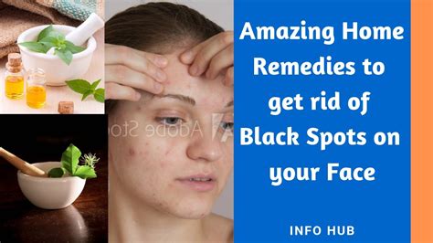 Amazing Home Remedies To Get Rid Of Black Spots On Your Face Youtube