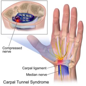 Nerve Entrapments Carpal Tunnel Syndrome Cts Health House Clinics