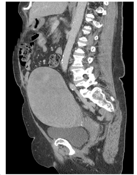 ct pelvis showing the large necrotic uterine mass download scientific sexiz pix