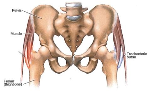 Gluteal Tendinopathy Causes Symptoms Treatment And Prognosis