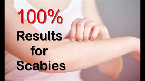 How To Get Rid Of Scabies With Natural Remedies And Scabies Treatment