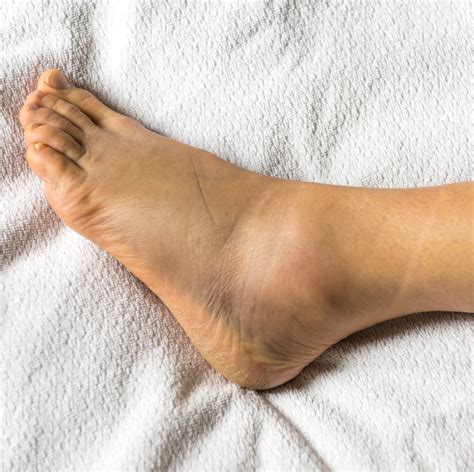 Doctors Explain 12 Reasons You May Be Dealing With Swollen Ankles Swollen Knee Swollen Ankles