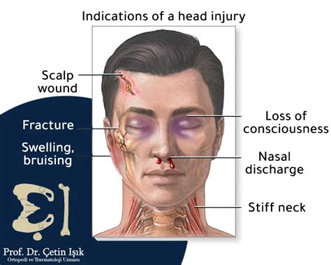 Skull Fractures The Most Important Symptoms And Treatment Methods