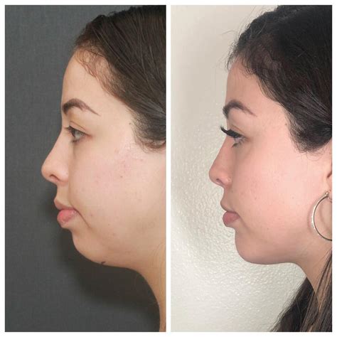 Buccal Fat Removal Before And After Patient 01 Nayak Plastic Surgery