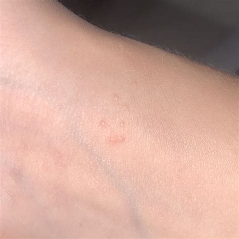 What Are These Small Bumps On The Palm Of My Hand I First Noticed A