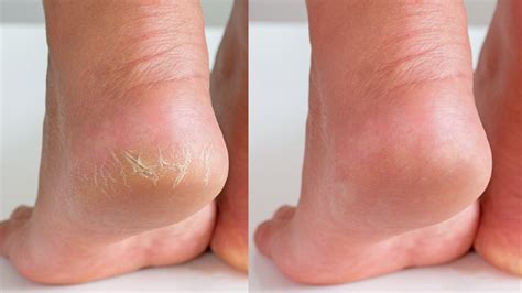 Kuraiy Best Chapped Hand And Foot Cream Crack Peeling Repair Anti Dry Skin Remove Dead Skin Foot