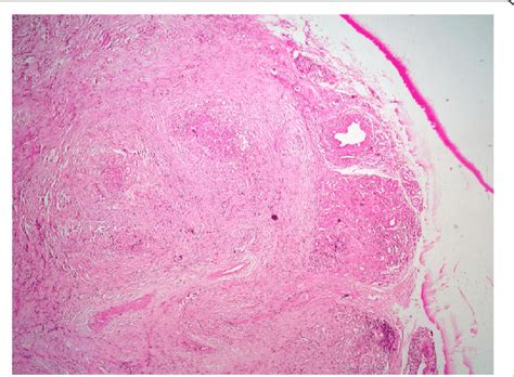 Low Magnification Showing A Lesion With Fascicular Architecure In A