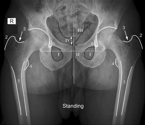 Standing Anteroposterior Pelvic Radiograph 1 Femoral Shaft 2