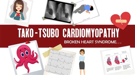 Takotsubo Cardiomyopathy Broken Heart Syndrome Sudden Death Syndrome Ecg Echo Meaning