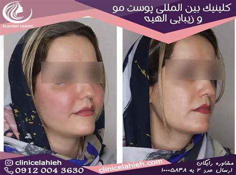 دکتر خوب برای تزریق چربی در تهران کلینیک بین المللی پوست مو و زیبایی الهیه