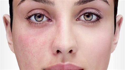 How To Get Rid Of Redness On Face Causes Of Redness On Face Artofit