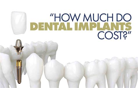 What Does A Dental Implant Cost Dental News Network