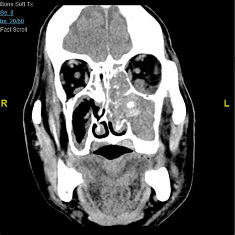 What Is A Fungal Sinusitis Isaac Namdar Md