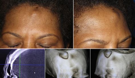 Forehead Osteomas And Their Treatment