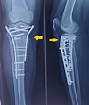 Cureus | Tibial Plateau Fracture with Avulsion Fracture of Tibial ...