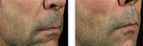 Juvederm Xc Dermal Filler For Wrinkles Nasolabial Folds And Lips