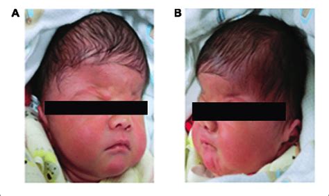 Head Features Of The Apert Syndrome Patient A Craniosynostosis