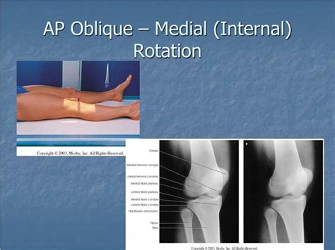 Knee Oblique Internal X Ray Polymed Lab