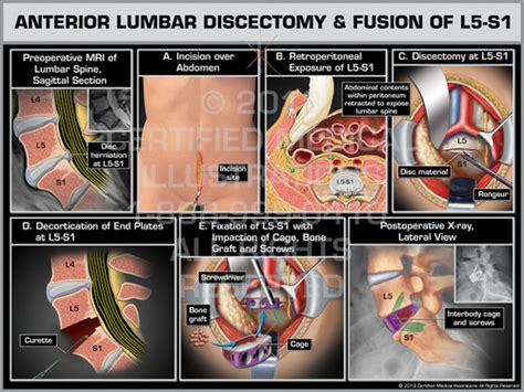 Anterior Lumbar Discectomy And Fusion Of L5 S1 Print Quality Instant