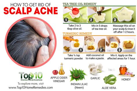 How To Get Rid Of Scalp Acne Top 10 Home Remedies