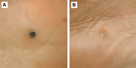 Skin Lesions Of Tungiasis A Dark Blue To Blackish Nodule Diameter