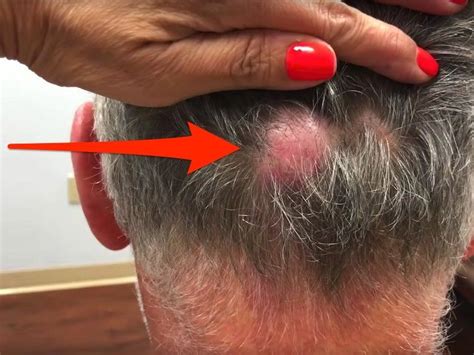 Cyst Ingrown Hair How To Remove 125 Best Haircuts In 2020