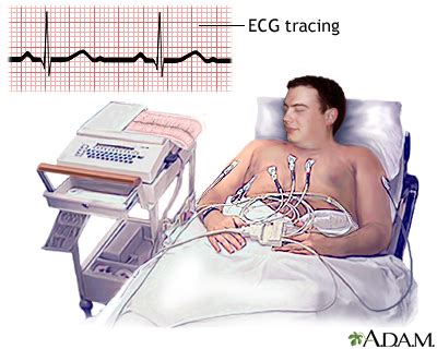 Electrocardiogram UF Health University Of Florida Health