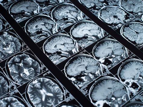 Some Steroids ‘may Change Brain Structure Study Guernsey Press