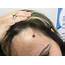 Derm Dx A Bleeding Mole On The Forehead  Dermatology Advisor