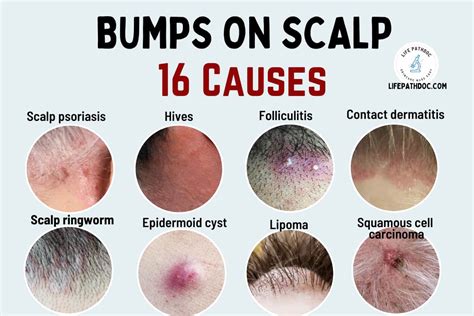 Bumps On The Scalp 16 Causes Pictures And Treatment