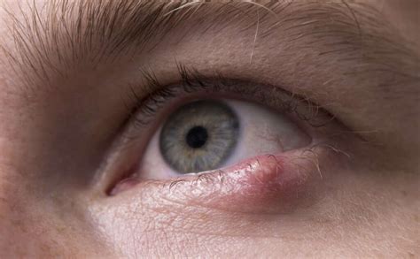 Eye Cancer 10 Symptoms Of Eye Cancer
