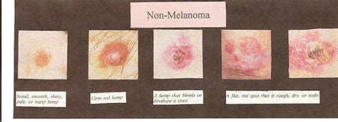 Non Melanoma Skin Cancer