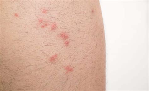 Flea Bites On Humans Pictures And Tips Nextgen Pest Solutions 2023