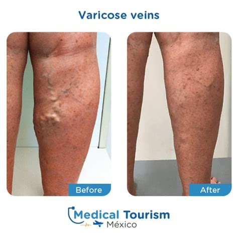 Vascular Surgeons For Varicose Veins Medical Tourism Mexico