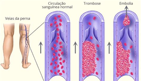 Trombose Veja As Principais Causas E Tratamentos Biosom