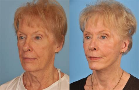 best facelift and neck lift plastic surgeon in toronto ford plastic surgery
