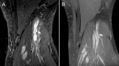 Case Of Intraneural Ganglion Cyst Reported By Jose Et Al 26 Which