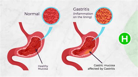 Gastritis Causes Symptoms Diagnosed Treatment And Healing