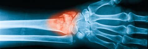 10 Facts To Know About Your Wrist Fracture Procedure Rothman