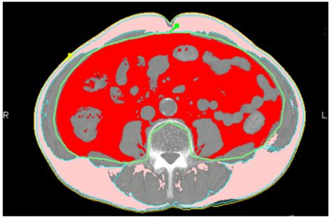 Distribution Of Abdominal Fat As Measured By Fatscan Software On A Ct