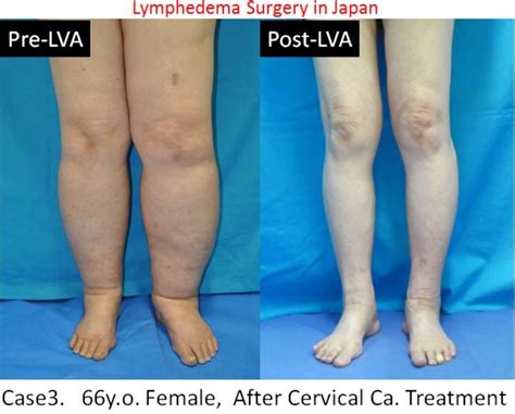 Lymphedema Treatment Japan Mominoki Day Surgery Clinic In Japan