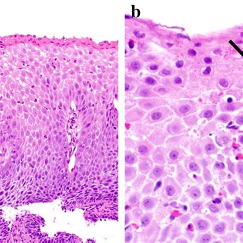 Examples Of Ringed Esophagus Or Trachealization A Front Double