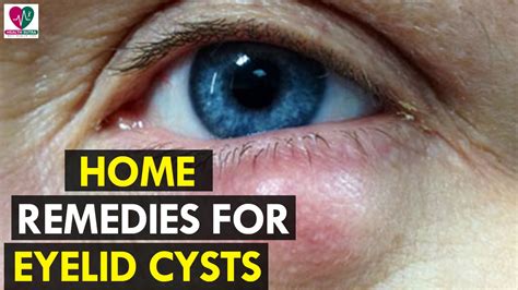 Home Remedies For Eyelid Cysts Health Sutra Youtube