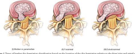Figure 1 From Surgical Treatment Of Far Lateral Lumbar Disc Herniation