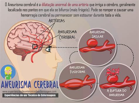 O que é aneurisma cerebral? Pin em bom dia