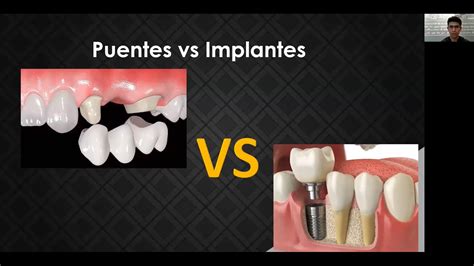 Puentes vs implantes dentales Por qué es mejor un implante dental