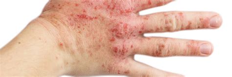 Hand Eczema And Dermatitis