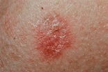 pics of skin cancers - pictures, photos